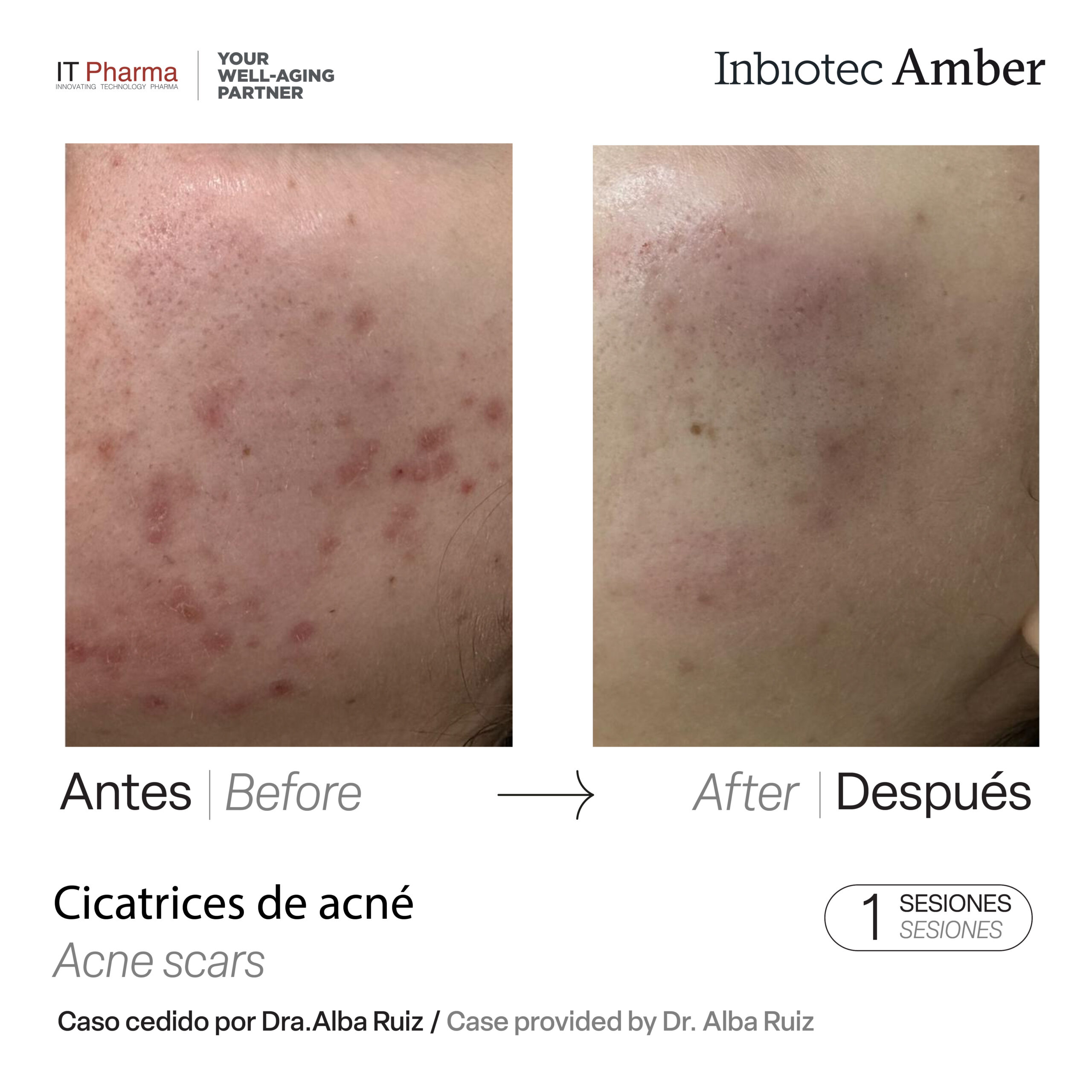 Tratamiento cicatrices acné Inbiotec Amber Dra. Alba Ruiz